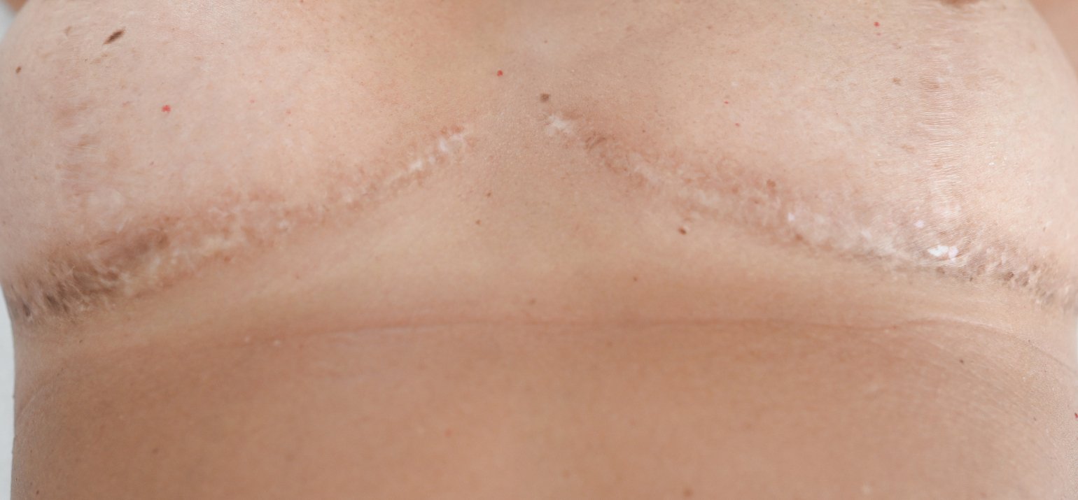 Behandeling litteken na borstreductie 