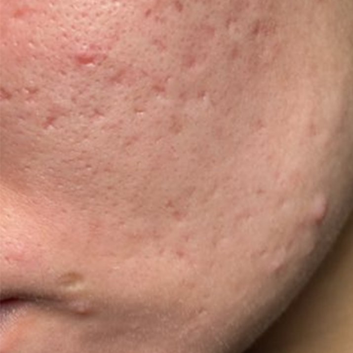 Oplossing voor littekens van acné